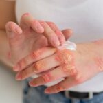 What is Eczema?