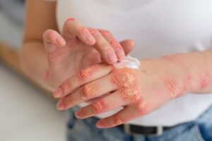 What is Eczema?