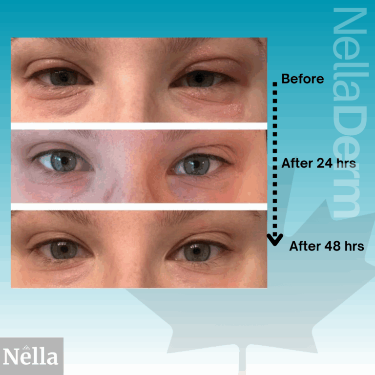 eczema cream for face