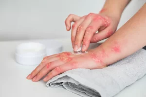 Top Tips for Managing Eczema in the Winter 