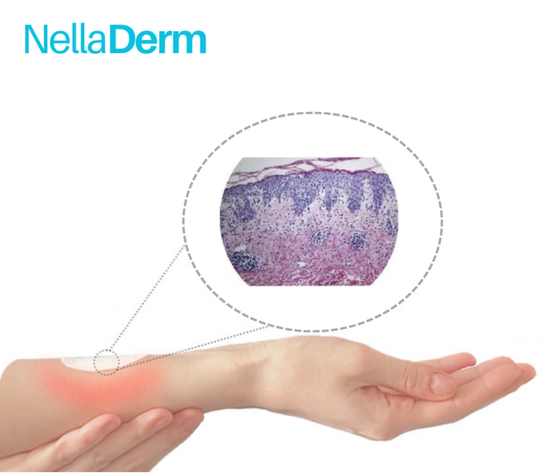 Eczema treatment