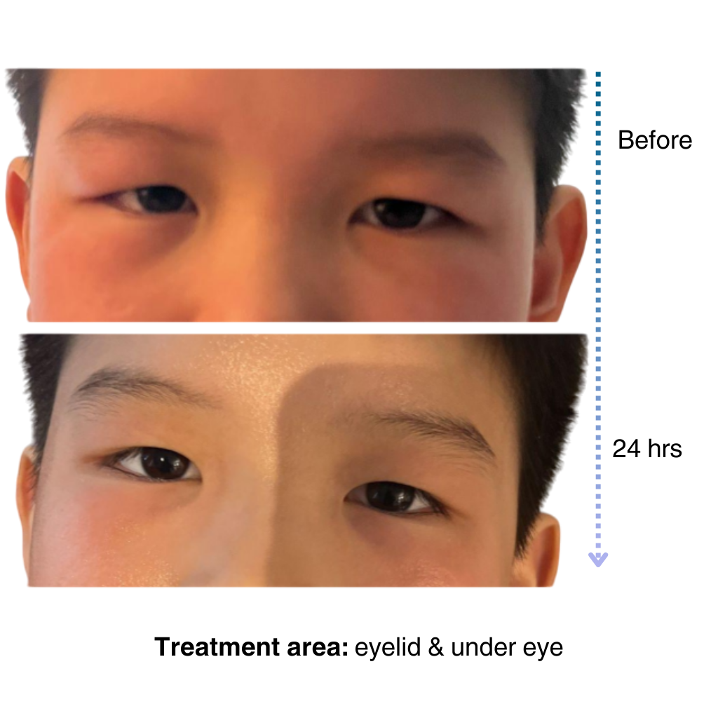 premium natural eczema product for baby