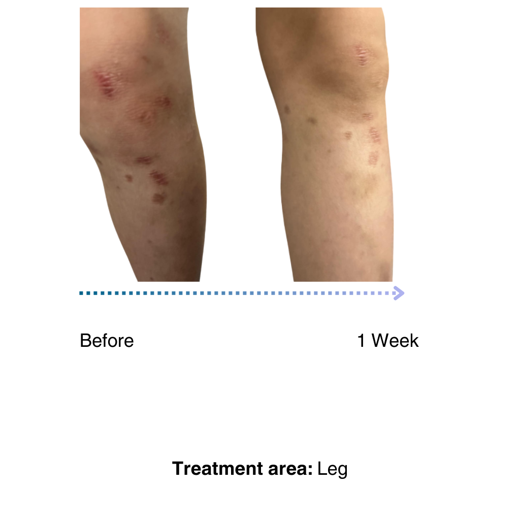 premium natural eczema treatment for kids