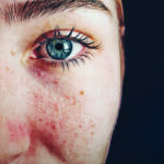 Hormones and eczema