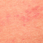 eczema flare-up length - eczema dry patch