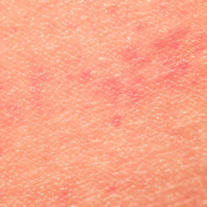 eczema flare-up length - eczema dry patch