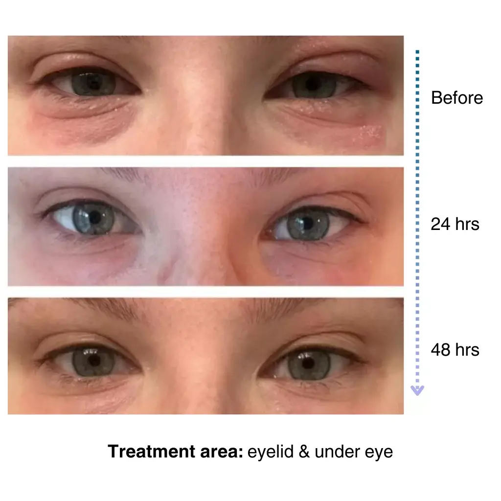 steroid free cream for eye eczema treatment