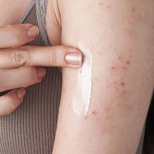 topical steroid withdrawal for eczema