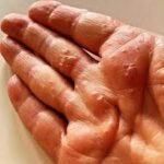 dyshidrotic eczema