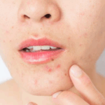 perioral eczema