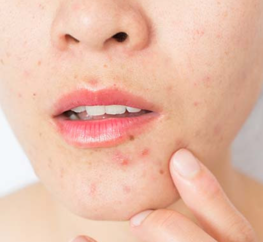 perioral eczema